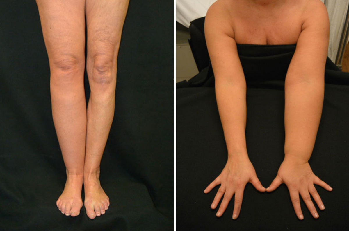 Чем опасны лимфатические отёки ног? Лимфостаз нижних конечностей